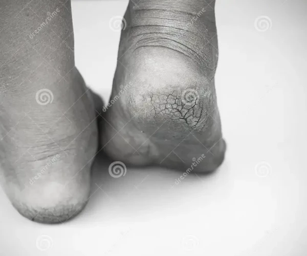 Santé du pied et personne âgée
